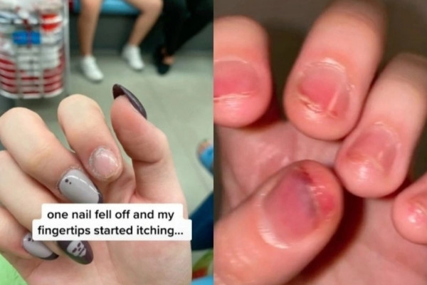 Móng tay sưng tấy, chảy mủ sau khi làm nail ở Singapore