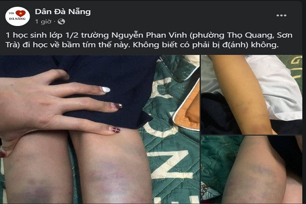 Học sinh lớp 1 ở Đà Nẵng tay chân bầm tím sau buổi học