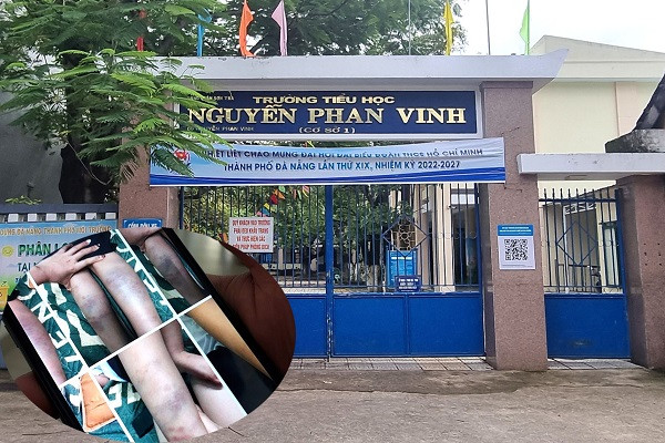 Vụ học sinh bầm tím chân tay: Phụ huynh bất ngờ không đồng ý với kết luận 'bạn đánh'