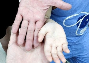 Hình ảnh bàn tay trẻ trắng toát được bác sĩ chia sẻ cảnh tỉnh bao bố mẹ