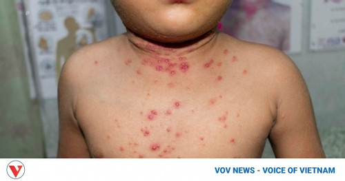 Vietnam adds monkeypox to group of infectious diseases