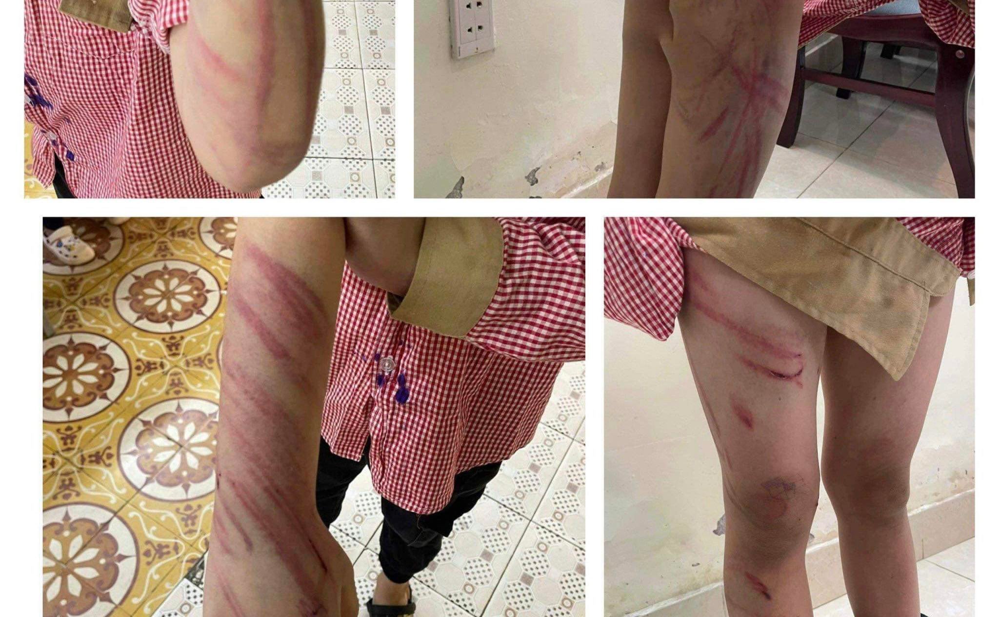 Bé 8 tuổi bị đánh tím tái toàn thân: Triệu tập người tình của mẹ