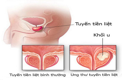 Khám ‘trên bảo dưới không nghe’, giật mình phát hiện ung thư