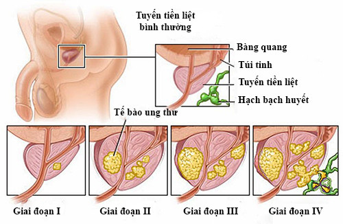 Ung thư tuyến tiền liệt: Có thể chữa khỏi