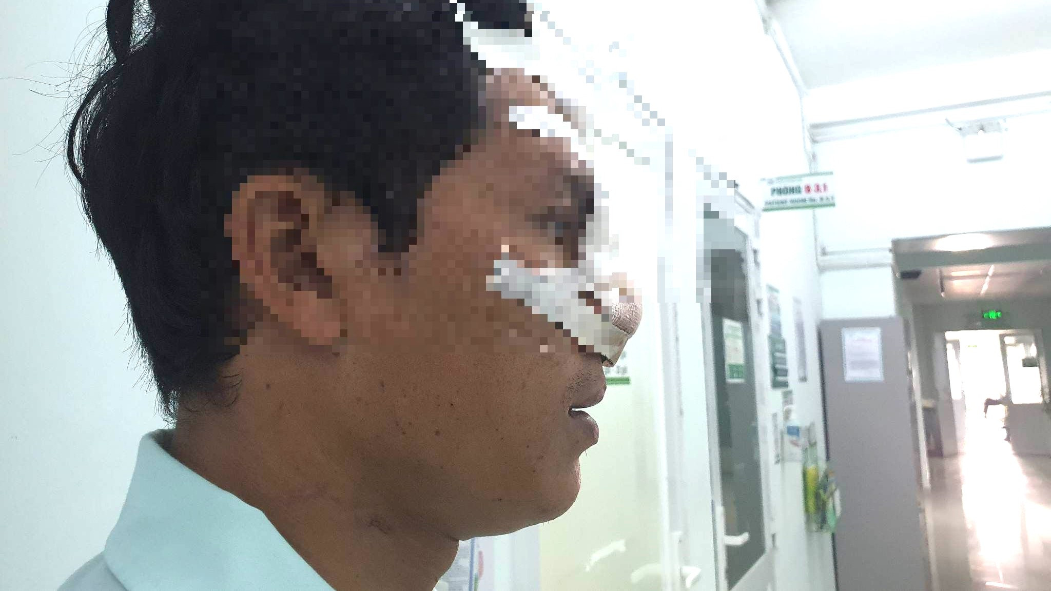 Bị bạn cắn đứt mũi vì can đánh nhau trên bàn nhậu