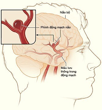 Bệnh phình mạch máu não rất nhiều người Việt bị chỉ qua cơn đau đầu