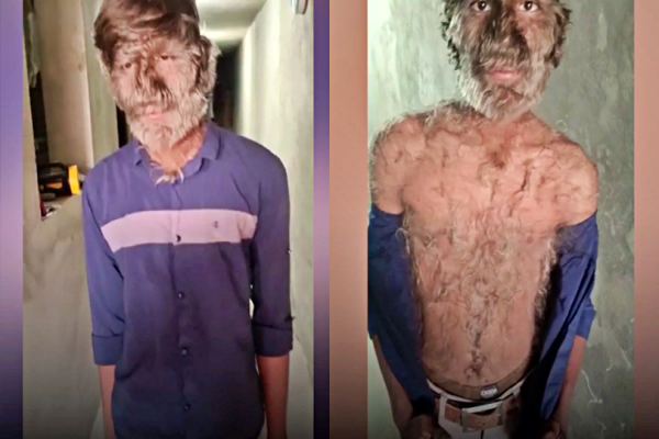 Chàng trai 'người sói' mắc bệnh kỳ lạ ở Ấn Độ