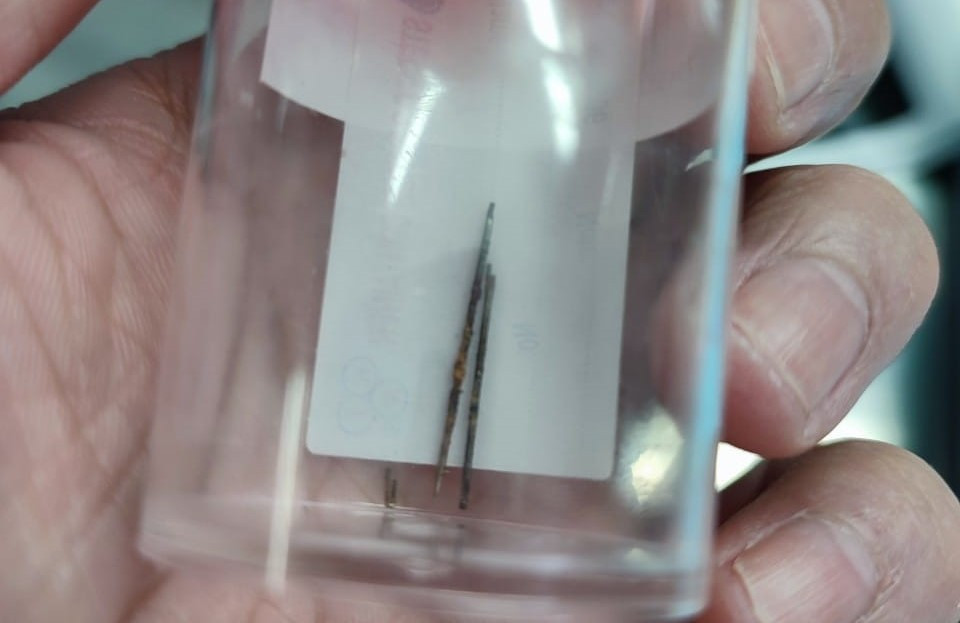 Bất ngờ phát hiện kim khâu nằm trong phổi bé trai 4 tuổi