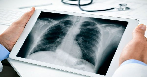 Khiến gần 24.000 người Việt tử vong mỗi năm, ung thư phổi có di truyền không?
