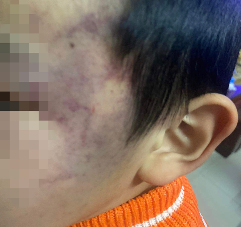 Bé trai 4 tuổi bị con cô giáo đánh tại trường