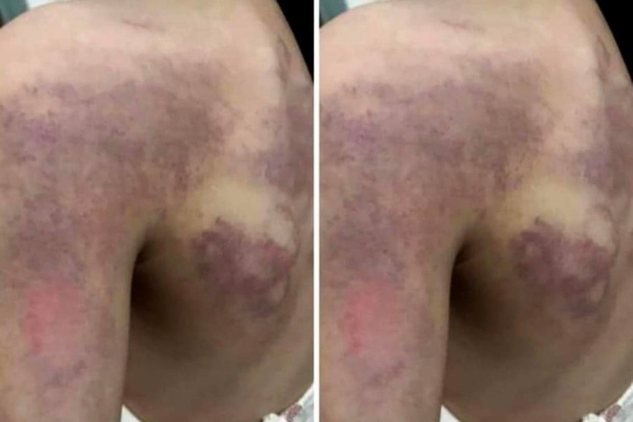 Nghệ An xác nhận vụ giáo viên đánh tím vai học sinh lớp 3