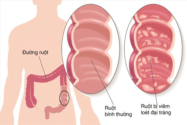 Lợi ích của bào tử lợi khuẩn trong hỗ trợ điều trị viêm đại tràng