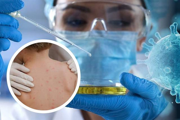 Vietnam monitors smallpox cases at border gates and hospitals