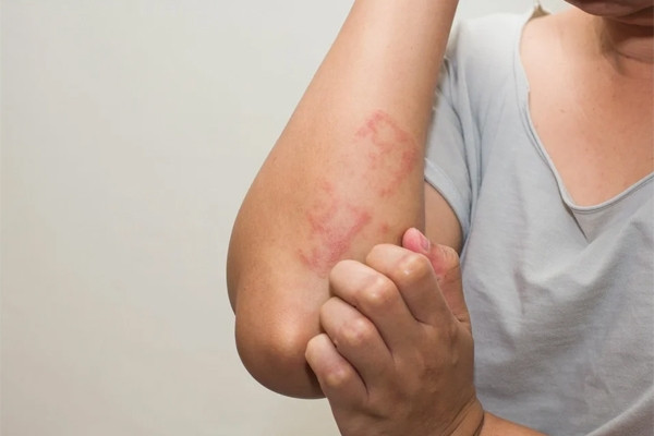 Difference between Covid-19 rash and monkeypox