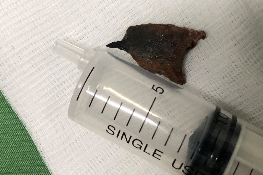 Mảnh xương ống bị bỏ quên trong phổi suốt 20 năm