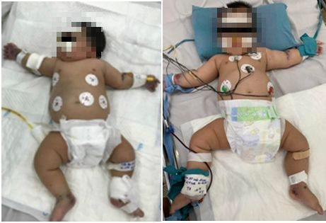 A 4-month-old girl has a heart attack due to dengue fever