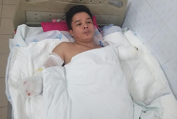 Bị bỏng điện cao thế,