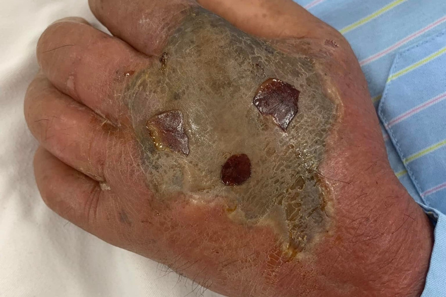 Suy đa tạng, hoại tử tay vì tự chữa rắn hổ mang cắn theo kinh nghiệm dân gian