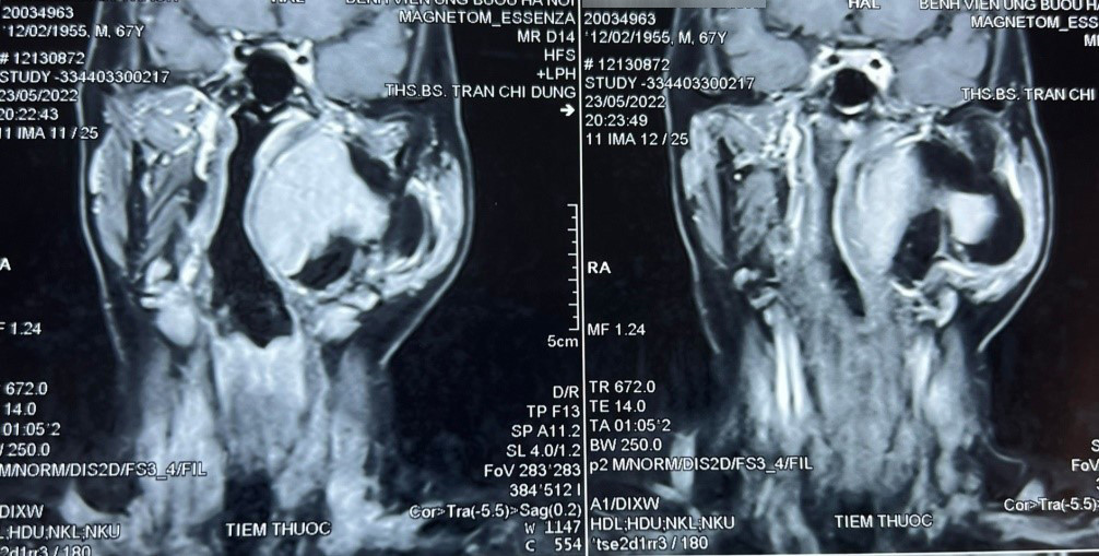 Người đàn ông có khối u vùng đầu cổ đường kính 10cm hiếm gặp