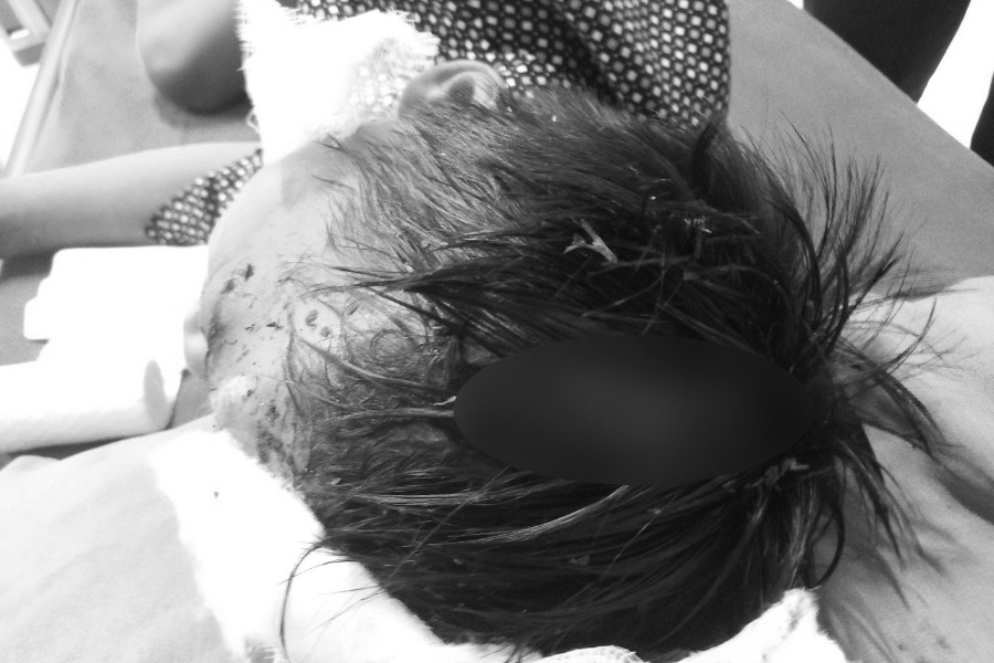 Chó cắn lộ xương sọ bé trai 8 tuổi