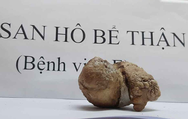 Thói quen thường gặp khiến thận mất hoàn toàn chức năng