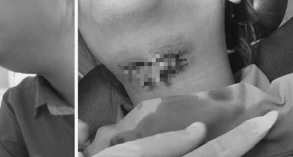 Lệch mặt vì chọc tăm vào vết sưng răng khôn 