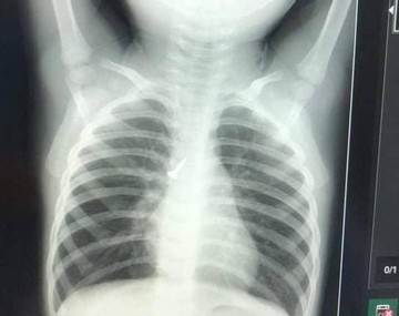 Chiếc đinh vít dài 1,5cm găm vào phổi bé trai 2 tuổi