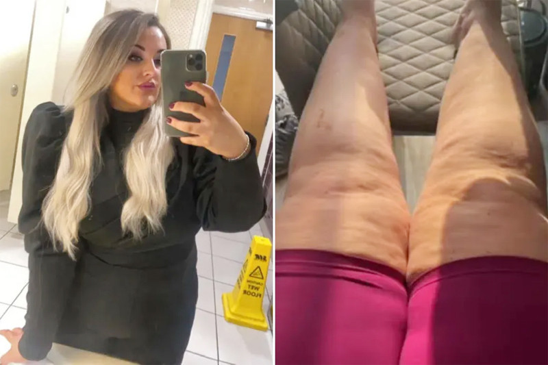 Bệnh phù mỡ lipedema làm tăng 44 kg dù chỉ ăn một bữa mỗi ngày