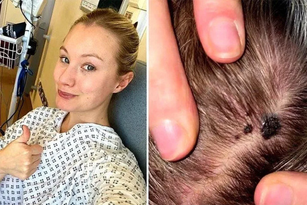 Cô gái 29 tuổi phát hiện ung thư từ vết lạ trên đầu