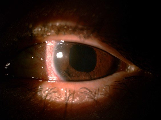 Tai nạn khi rửa xe, người đàn ông chịu cảnh mù mờ suốt 4 tháng