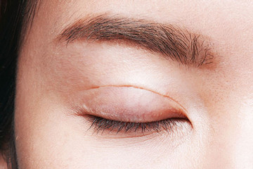 Người phụ nữ bị thủng 4 lỗ trong mắt, vỡ thuỷ tinh thể vì cắt mí