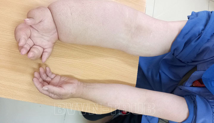 Hình ảnh cánh tay kỳ lạ của người phụ nữ mắc ung thư