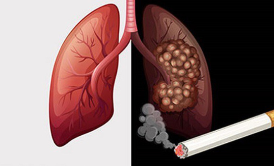 Hơn 20.000 người Việt Nam tử vong mỗi năm vì loại ung thư này