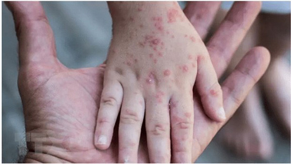 Mass vaccinations against monkeypox not currently recommended