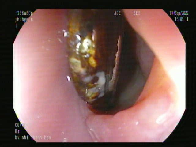 Bé trai 11 tháng tuổi nuốt cục pin vào thực quản