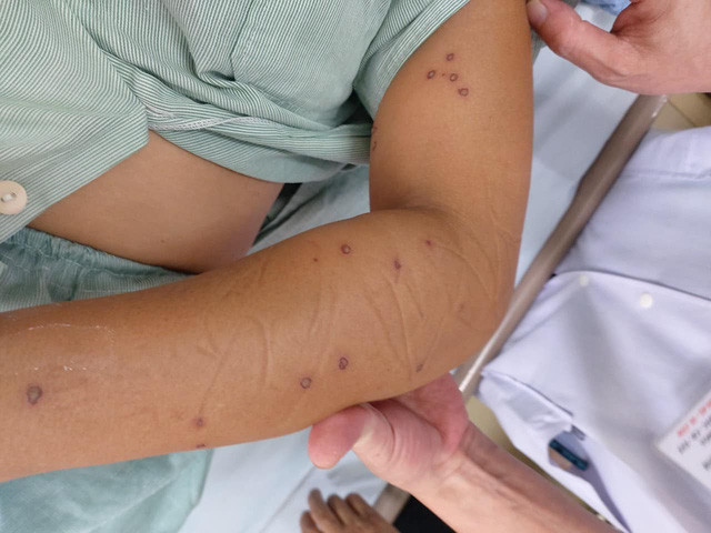 Cô gái trẻ nguy kịch vì 70 nốt ong đốt chi chít khắp người