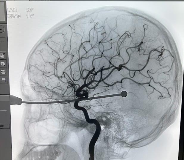Đoạn ăng ten 20cm cắm sâu làm mù mắt nam thanh niên sau cú va chạm giao thông
