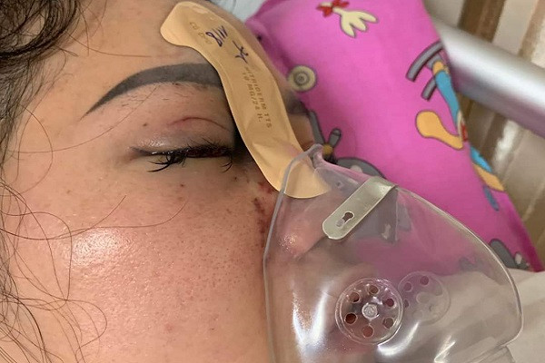 Cô gái 27 tuổi bị mù mắt phải sau khi tiêm filler nâng mũi
