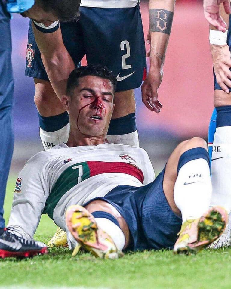 Ronaldo đổ máu ở vùng mặt sau khi lĩnh trọn cú đấm của thủ môn Vaclik trong pha không chiến ở phút 12. Cũng còn may cho Ronaldo là sau khi được các bác sỹ chăm sóc, anh vẫn có thể gắng gượng thi đấu hết trận chứ không phải rời sân giữa chừng.