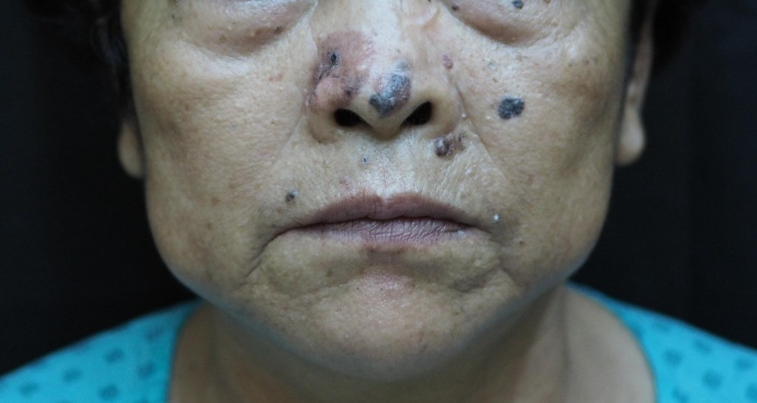 Ung thư thường gặp nhất ở người già với biểu hiện rất quen thuộc