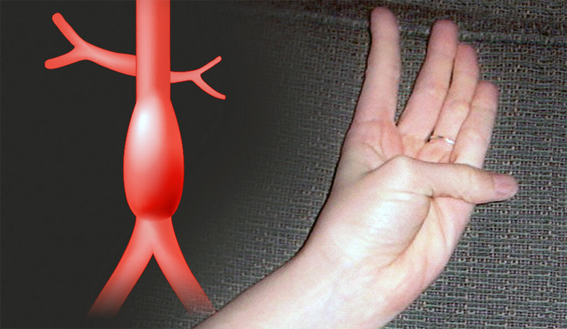 Bài kiểm tra bằng ngón tay cái phát hiện nguy cơ bệnh tim