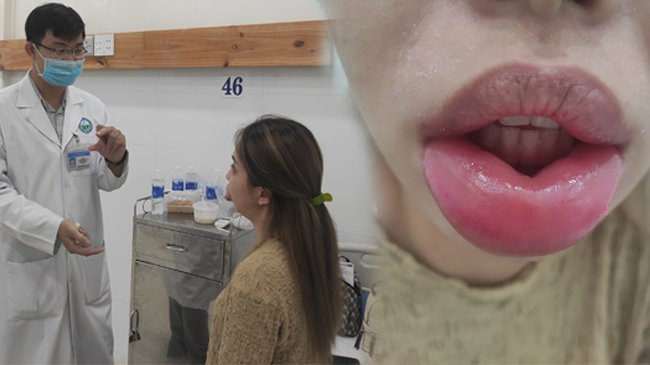 Môi sưng phồng, căng cứng vì biến chứng do tiêm filler ở spa