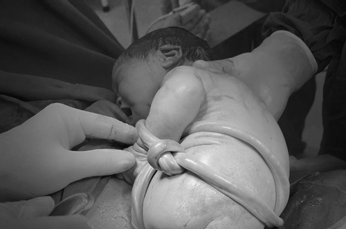 Em bé chào đời với dây rốn thắt nút và cuốn chặt thân