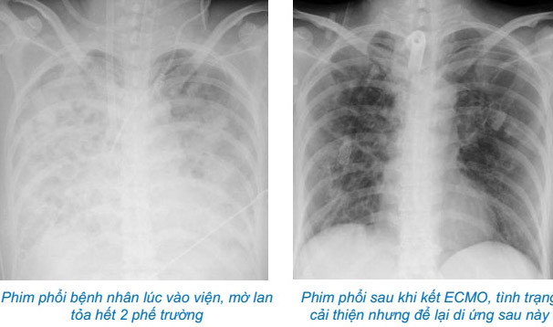 Suy đa tạng do sai lầm khi tự điều trị cúm