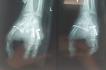 Dùng ngón chân ghép thay ngón tay cho bệnh nhân bị tai nạn lao động