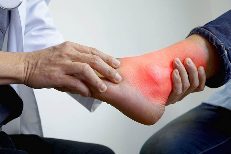 Bị bệnh gout có cần kiêng tuyệt đối protein từ thịt, cá, trứng?