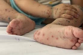 Hanoi reports increase in hand, foot, and mouth cases