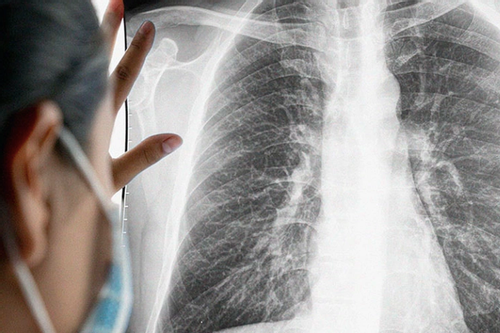 Thói quen có ở hàng triệu nam giới Việt khiến người đàn ông mất một lá phổi