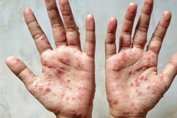 Da Nang detects suspected monkeypox case