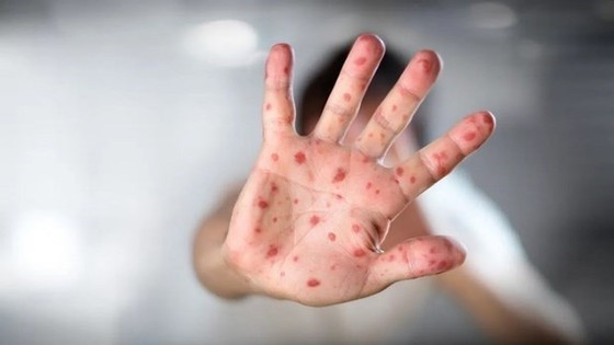 Of 20 monkeypox cases, 18 are diagnosed with B20 ảnh 1